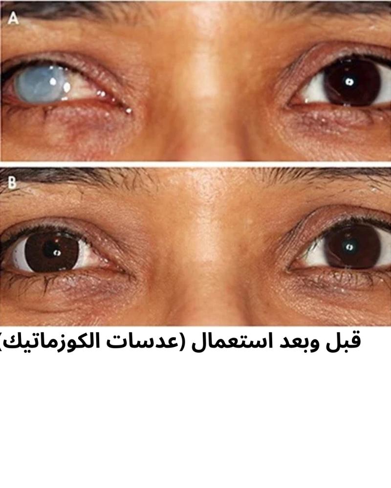 عدسات الكوزماتيك التجميلية