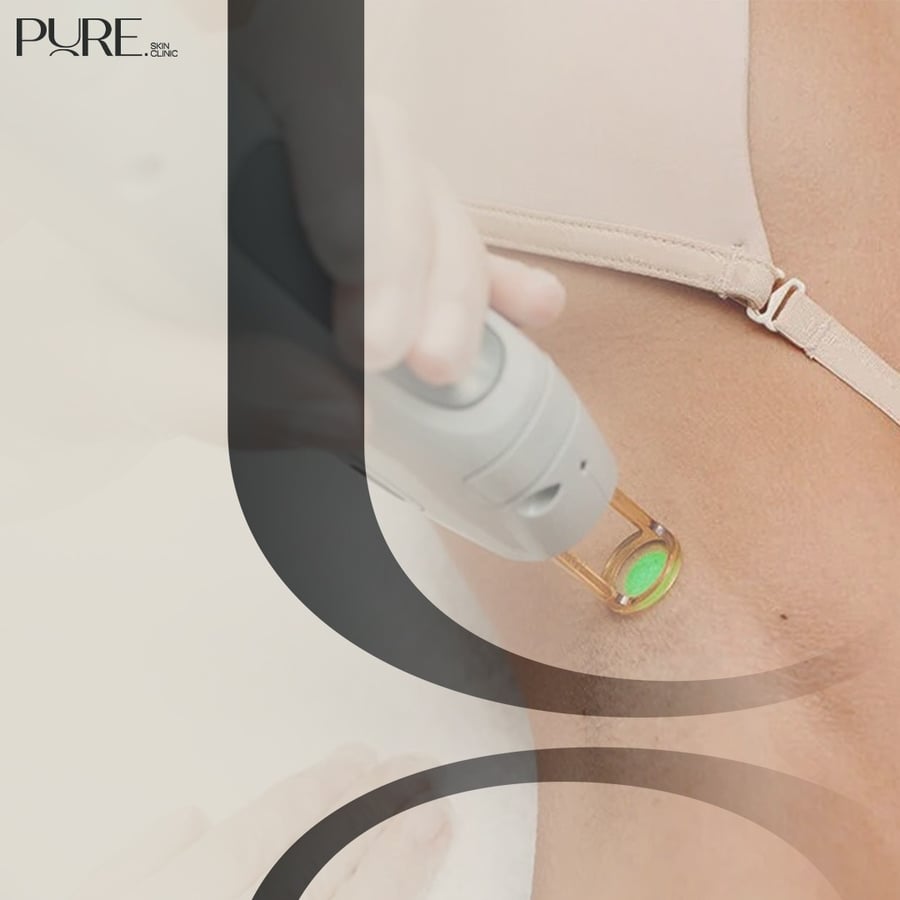 Underarm Laser Hair Removal Session