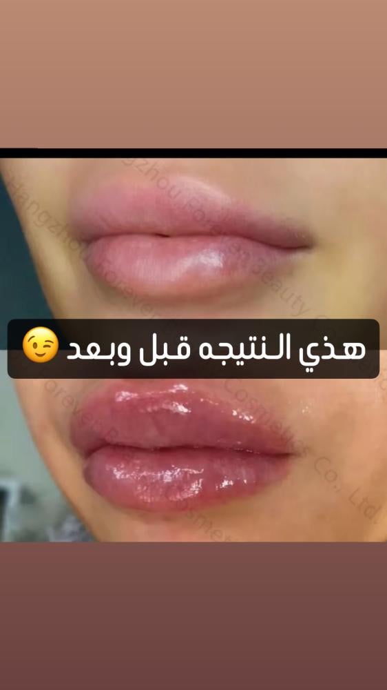 قلوس تكبير الشفاه من فاتن بيوتي
