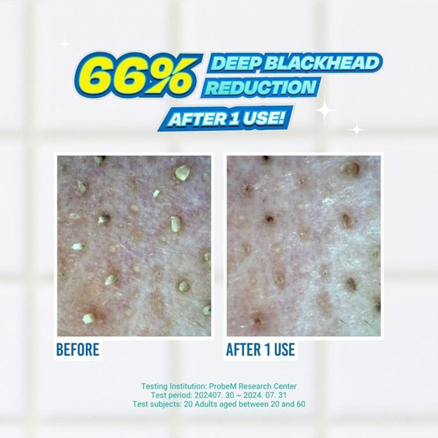 JUMISO Blackhead Melting Softener Special Set