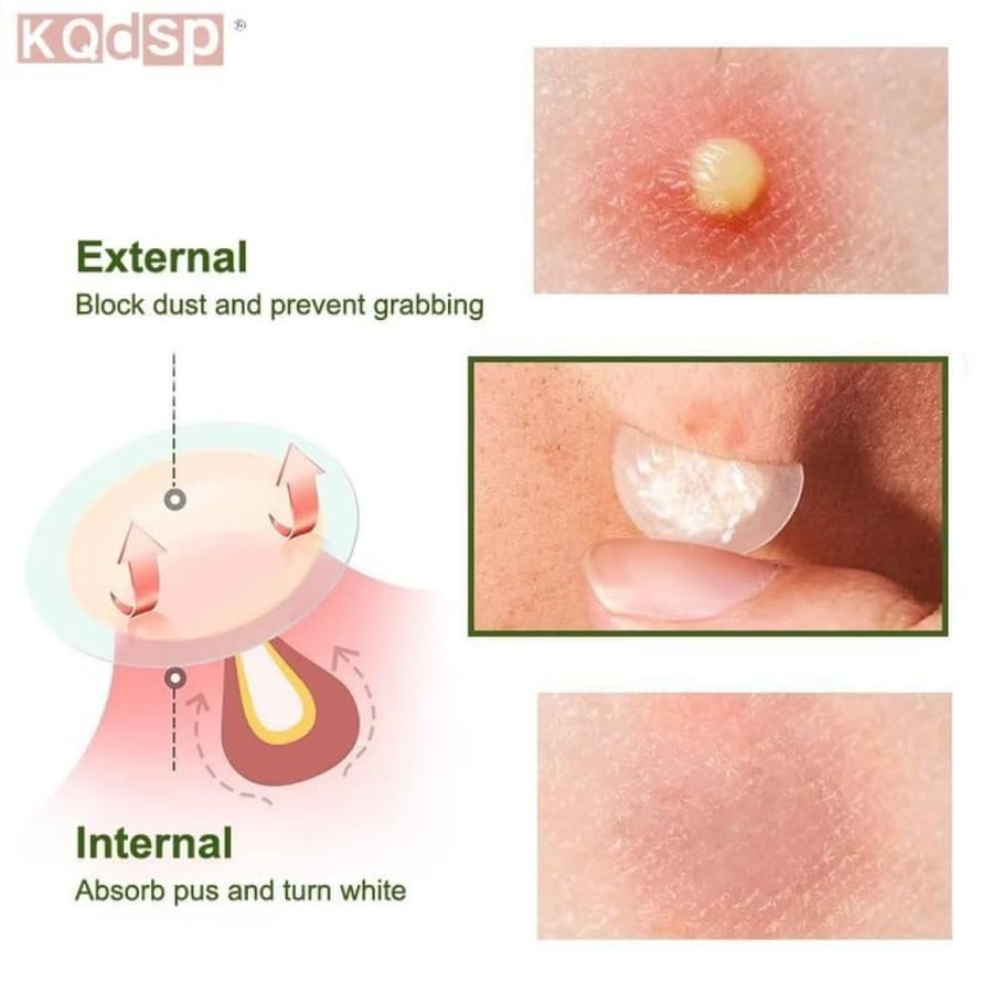 Anua  Triple Acid Spot Care Microdart Patch  أنوا مايكرو باتش لعلاج ال