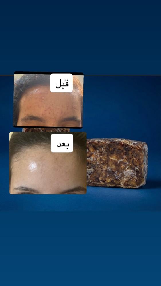 صابونية التفتيح العلاجية للحبوب