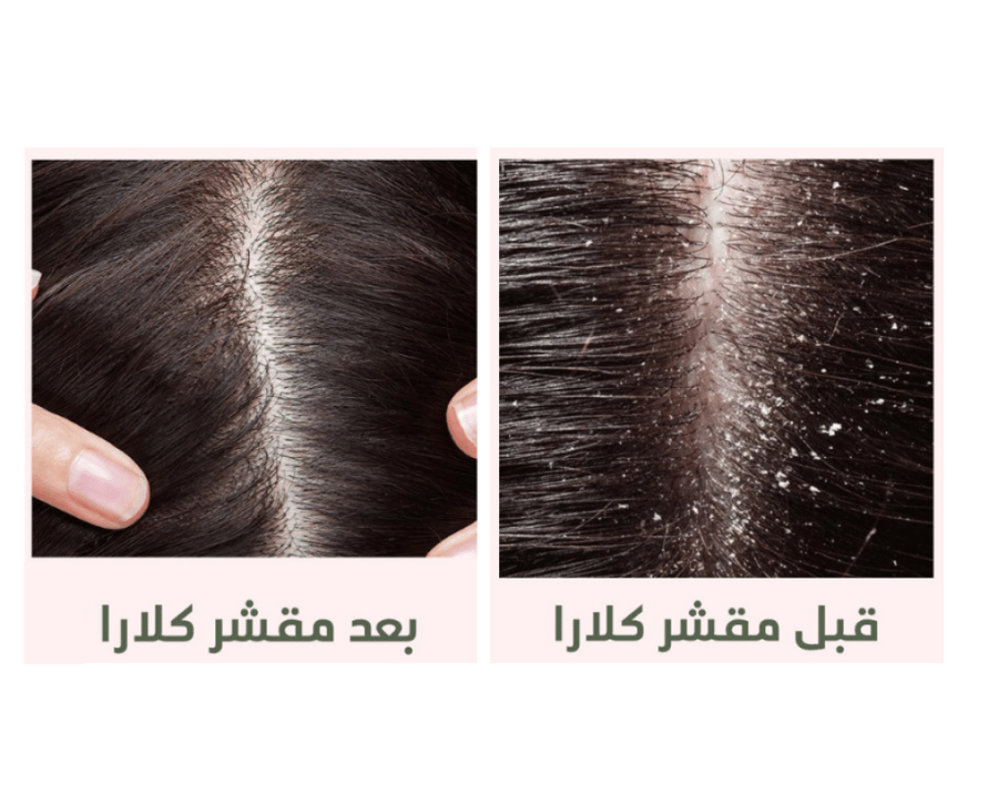 كلارا سكراب مقشر لتنظيف الفروة يزيل الخلايا الميتة
