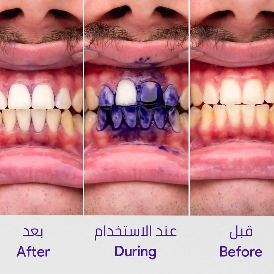 سيروم مصحح لون الأسنان V34 من هاي سمايل 30 مل تركيبة سائلة