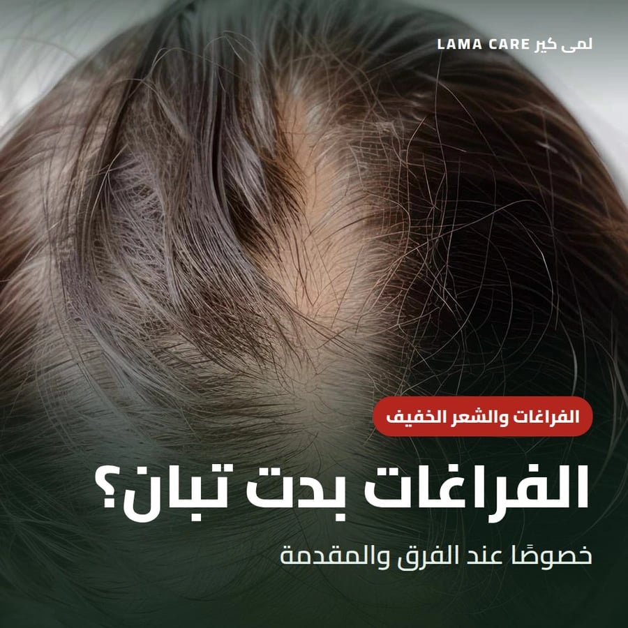 فراغات الشعر والشعر الخفيف عند الفرق ومقدمة الرأس