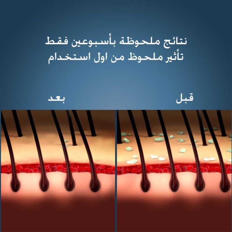 شامبو لعلاج قشرة الشعر والتهاب الجلد الدهني 100 مل من نيزورال