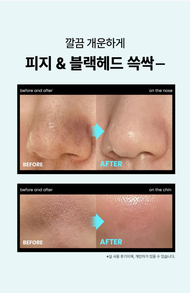 ilso Super Melting Sebum Softener مزيل الروؤس السوداء و البيضاء