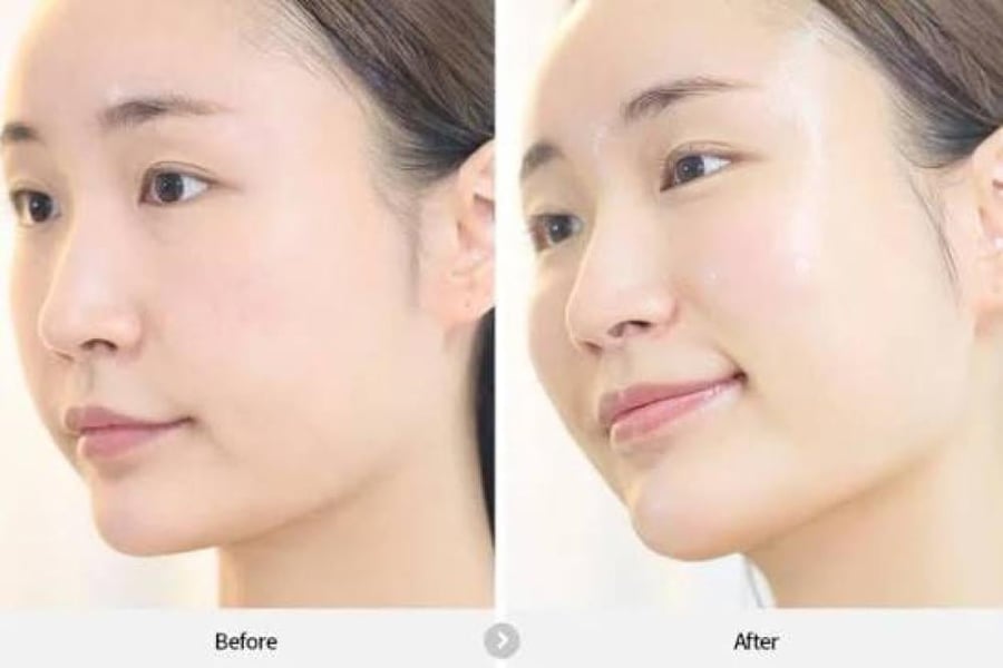 REJURAN Dual Effect Ampoule 50ml ريجوران - أمبول هيلر ديوال إيفكت المطور
