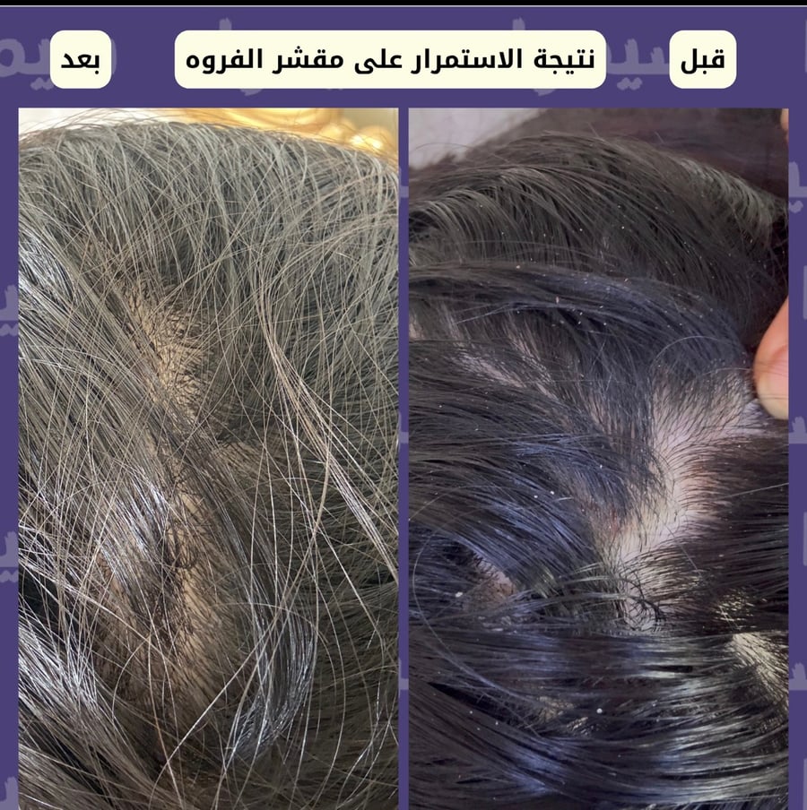 مقشر للفروه (طبيعي 100٪ مزيج من 27عشبه لعلاج الفروه وتطهيرها)
