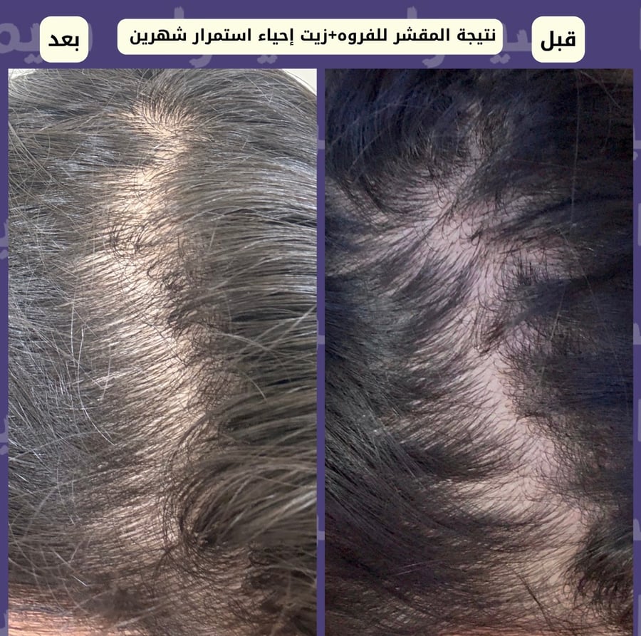 مقشر للفروه (طبيعي 100٪ مزيج من 27عشبه لعلاج الفروه وتطهيرها)