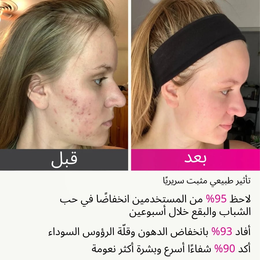 مرهم شمع العسل بتركيبة غنية بالإيبيلوبـيوم لدعم تجدد البشرة وتقليل الجفاف