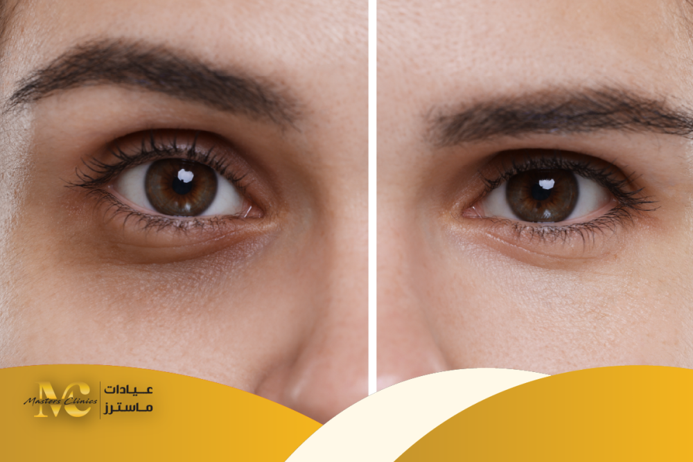 هل تعالج الديرما التصبغات والهالات؟