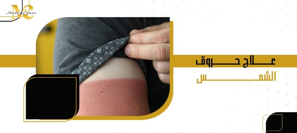 علاج حروق الشمس