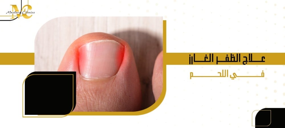 علاج الظفر الغارز في اللحم