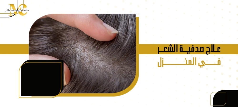 علاج صدفية الشعر في المنزل