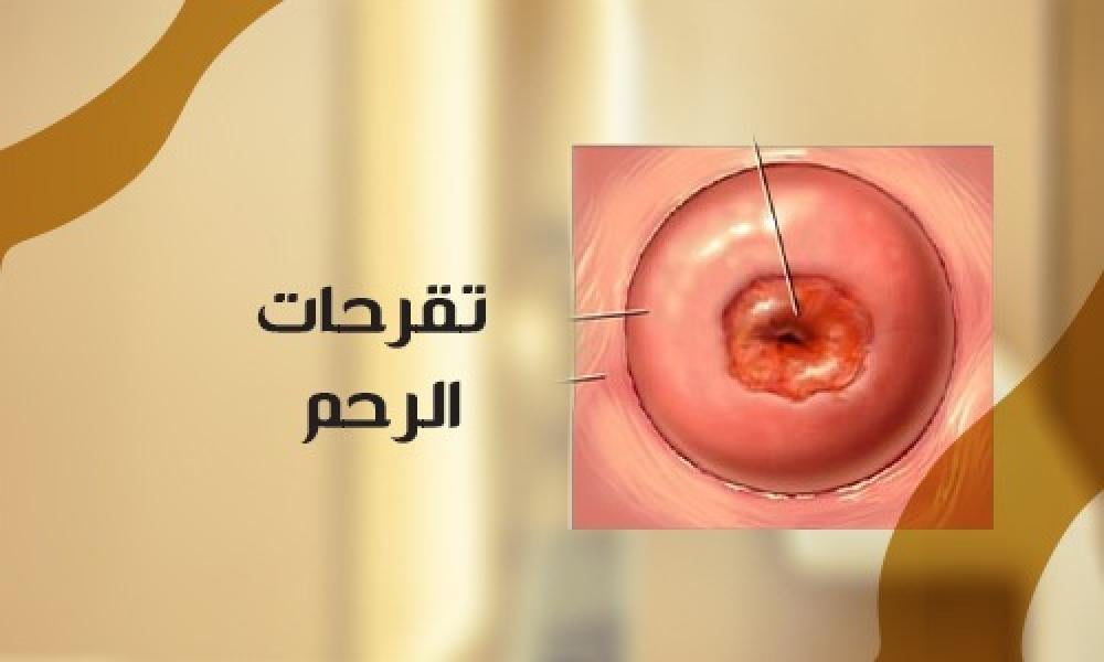 تقرحات الرحم: الأسباب، الأعراض، والعلاج الطبي المتخصص للحفاظ على صحة المرأة
