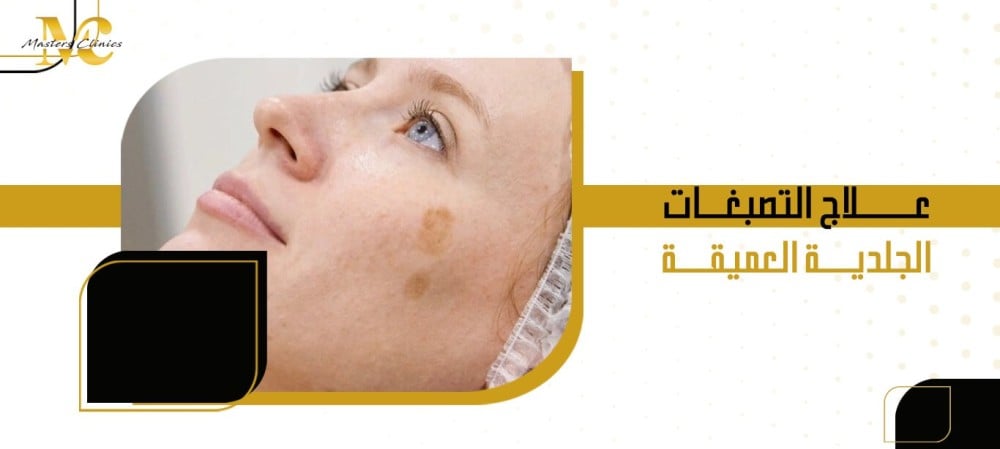 علاج التصبغات الجلدية العميقة