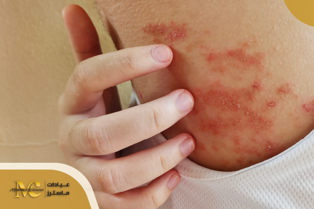 الفرق بين الصدفية و الاكزيما و طرق العلاج