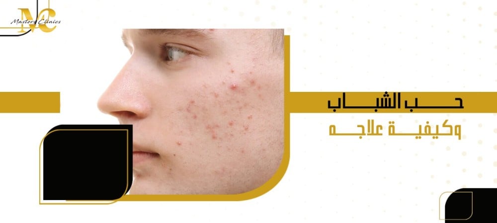 حب الشباب وكيفية علاجه