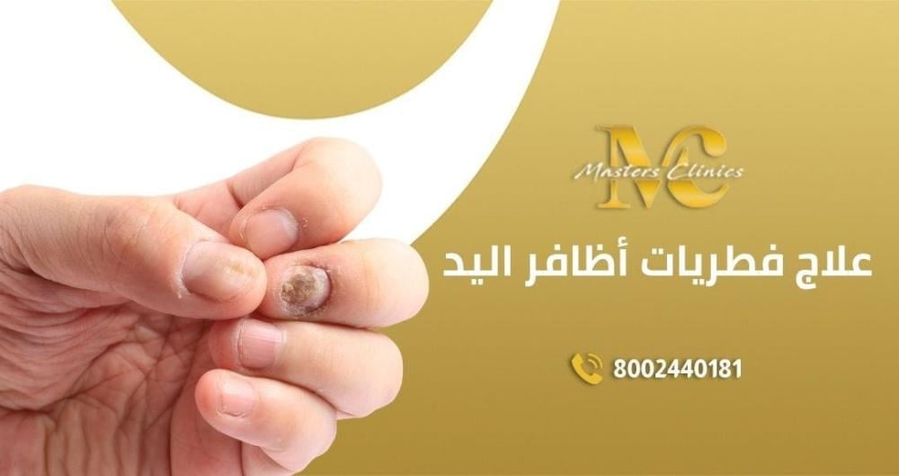 علاج فطريات أظافر اليد في عيادات ماسترز