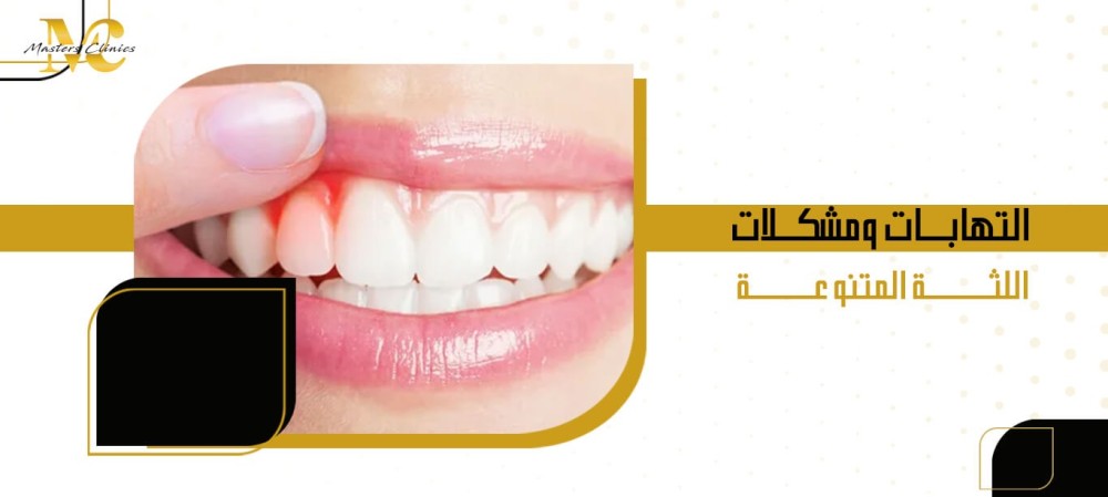 التهابات ومشكلات اللثة المتنوعة