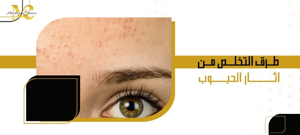 طرق التخلص من اثار الحبوب طرق التخلص من اثار الحبوب