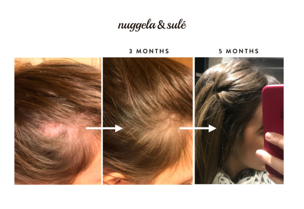 أمبولات نوجيلا آند سولي لعلاج تساقط الشعر: المكونات والأسباب والفوائد