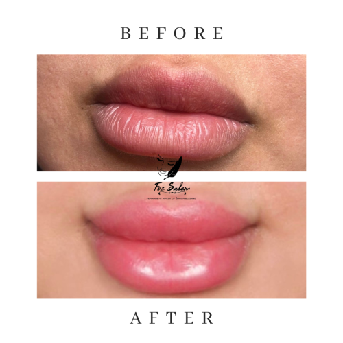 بكج الشفايف - Lips Micropigmentation