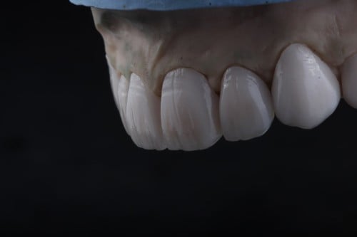 118 وجوه خزفية من الإيماكس 118 E.max veneers