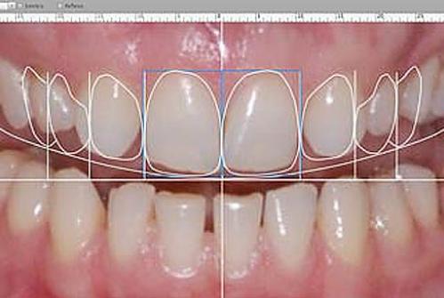 321. ابتسامة رقمة على صورة Digital Smile Design 2D