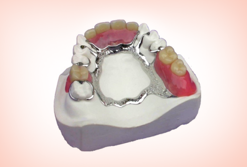 140 . طقم جزئي هيكل معدني Metal framework denture