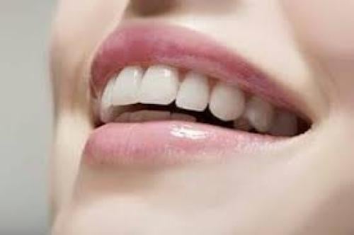 تبييض الأسنان بتقنية الفلاش + التنظيف