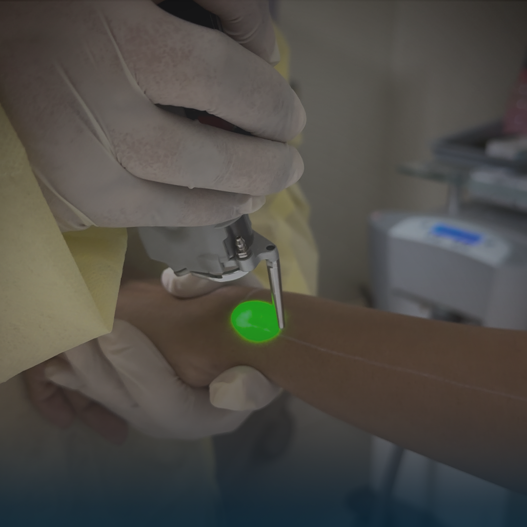 ليزر ازالة الشعر