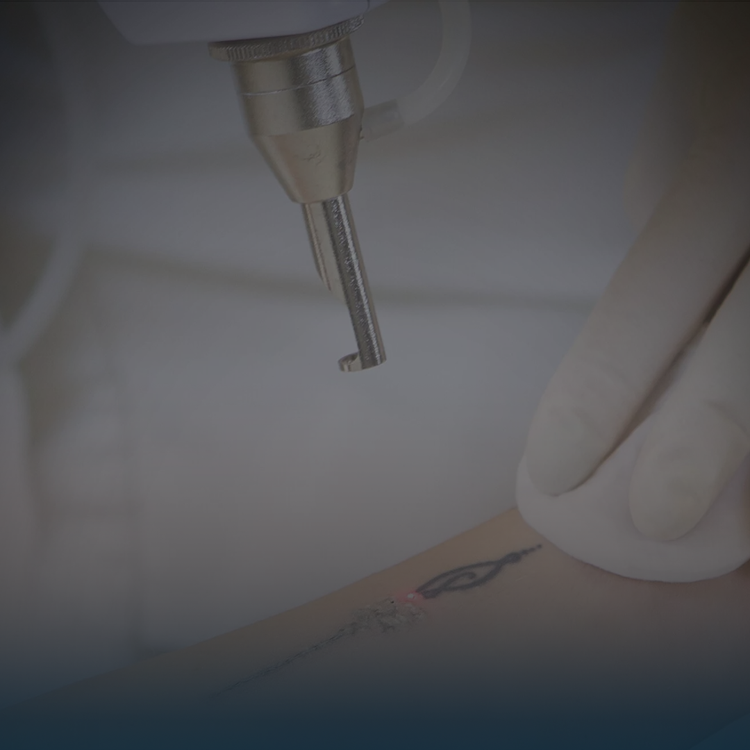 ازالة التاتو