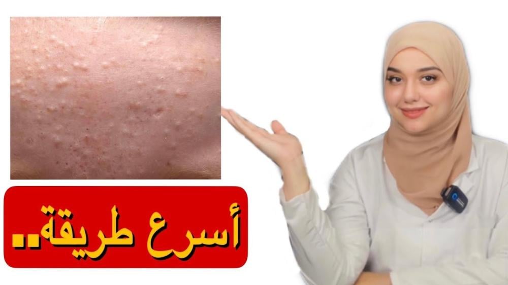 اسباب الحبوب في المناطق الحساسة للنساء