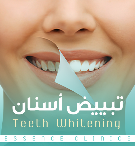 تبييض اسنان فكين - قوالب منزليه