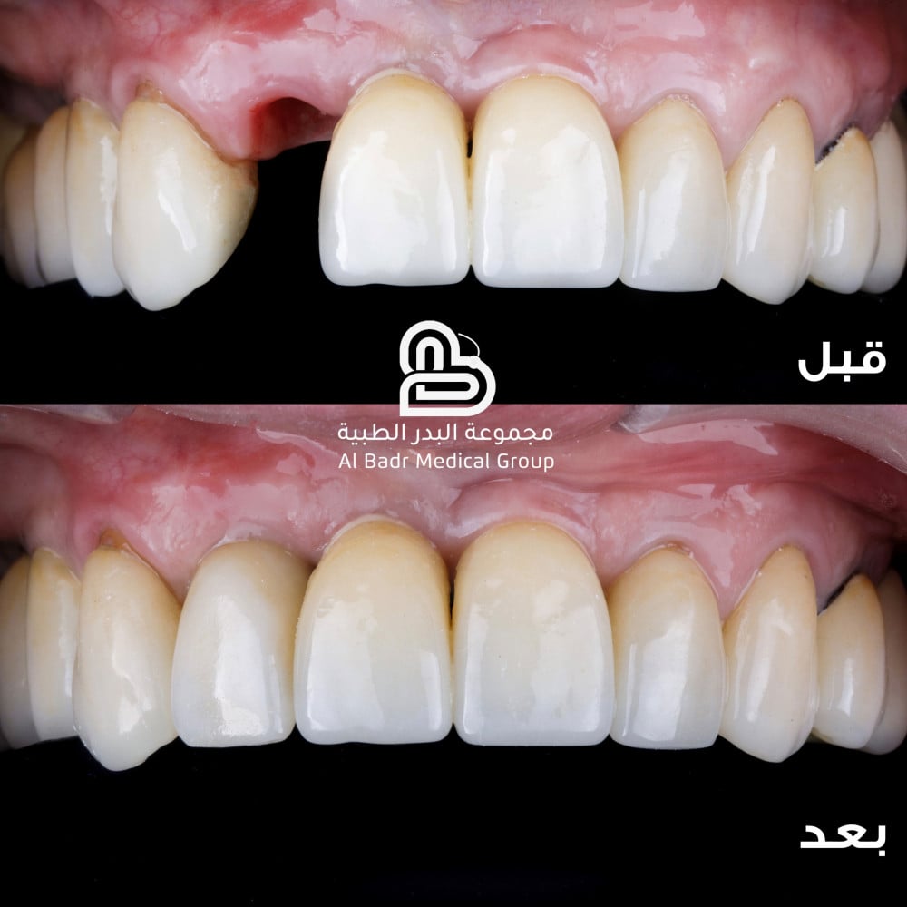 أفضل دكتور زراعة أسنان في مكة