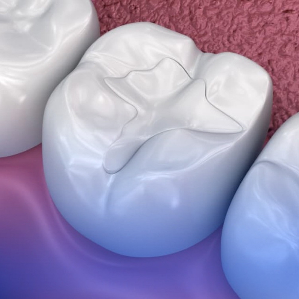 حشوات الاسنان التجميلية