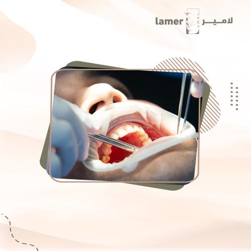 تنظيف وتلميع الأسنان