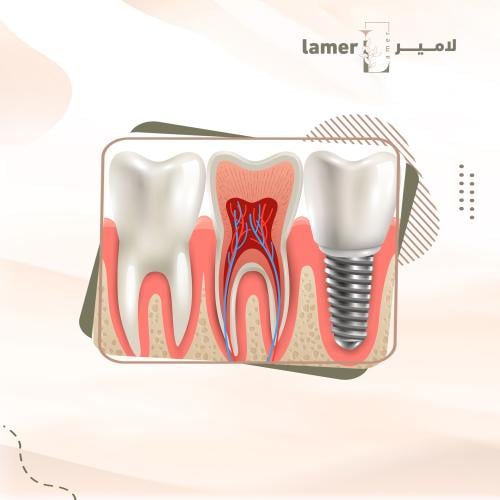 زراعة الأسنان الكورية OSSTEM + شامل التركيب زيركون