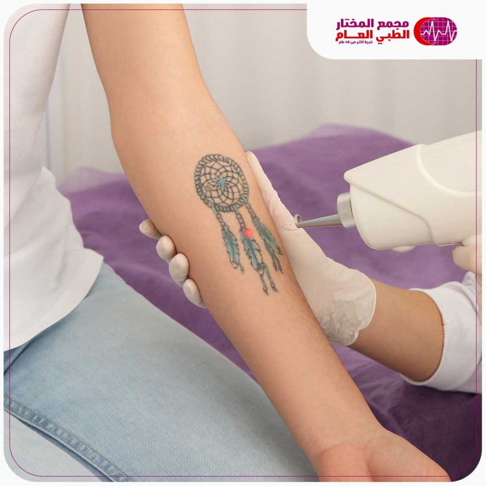 إزالة تاتو صغير