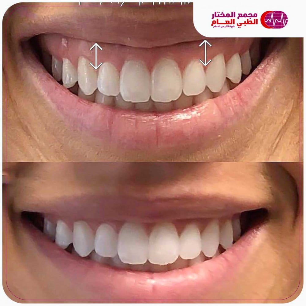 بوتوكس الابتسامة اللثوية + الرتوش مجاناً