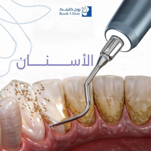 تنظيف و تلميع الاسنان تراكم جير بسيط - عروض الصيف