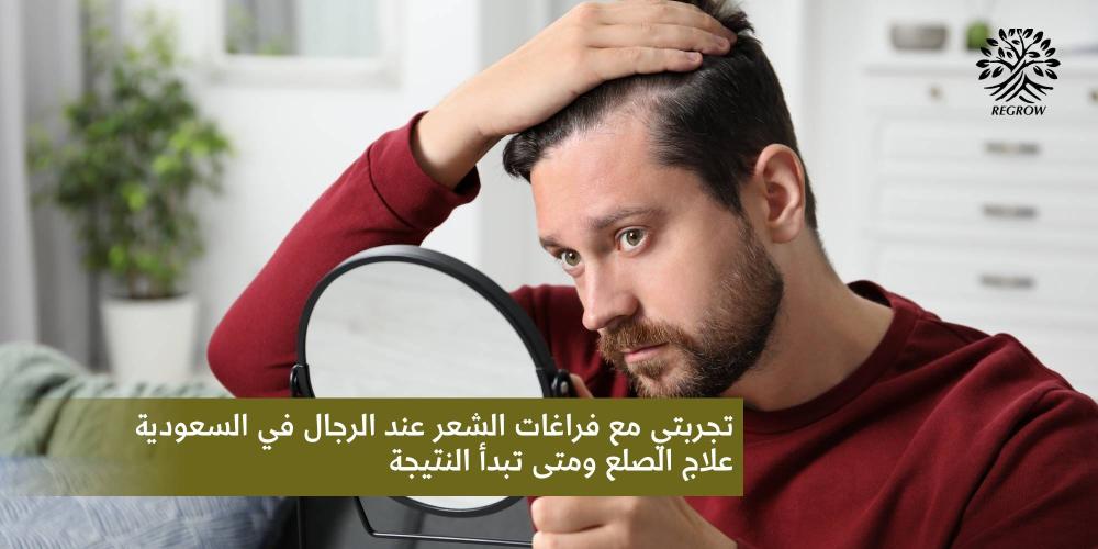 تجربتي مع فراغات الشعر لدى الرجال في السعودية | علاج فعال مع REGROW