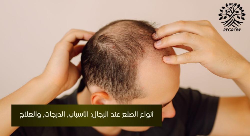 أنواع الصلع عند الرجال