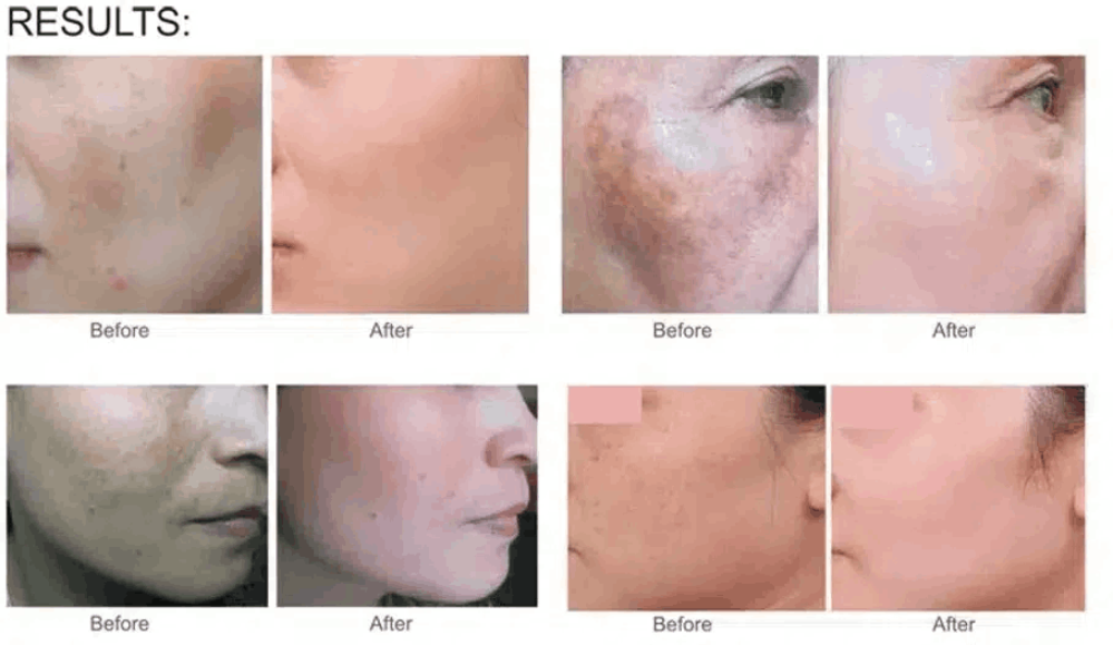 ميزوثيرابي تفتيح وايتنق من ام سي سي ام