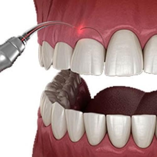 قص اللثة او توريدها للفك الواحد