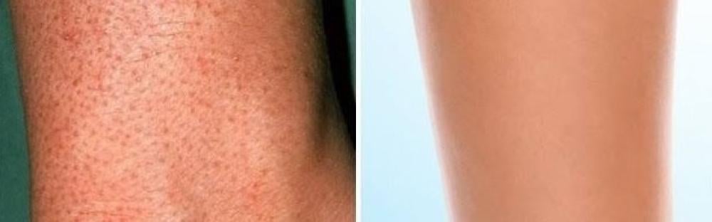 الدليل الكامل لعلاج جلد الوزّة والشعر تحت الجلد بدون ألم