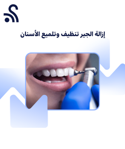 إزالة الجير تنظيف وتلميع الأسنان