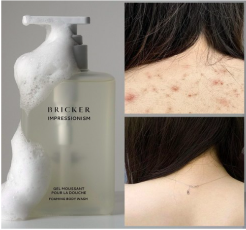 جل استحمام لبشرة جلد الدجاجة وحب شباب الجسم  مع تقشير خفيف للبشرة-